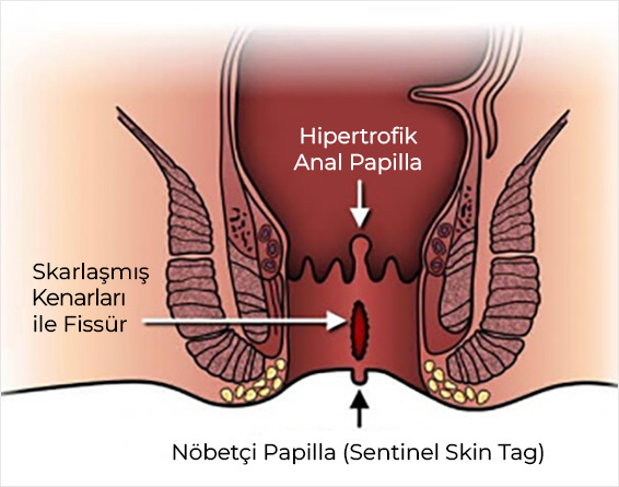 Anal Fissür (Çatlak)