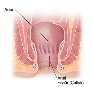 Anal Fissür Çatlak
