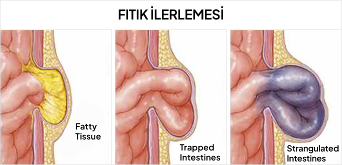 Fıtık İlerlemesi