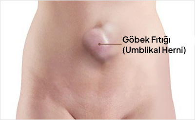 Göbek Fıtığı