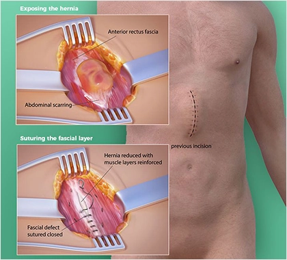 Kesi Yeri Fıtığı Ameliyatı Primer Onarım