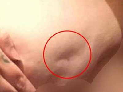 Meme kanseri belirtileri