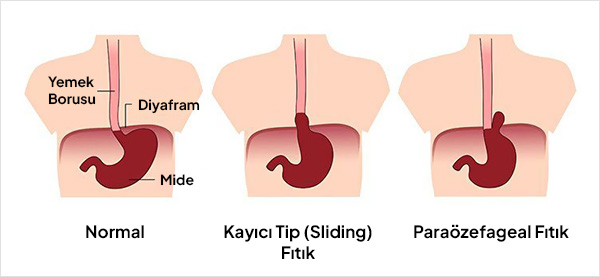Mide Fıtığı