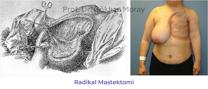 Radikal Mastektomi
