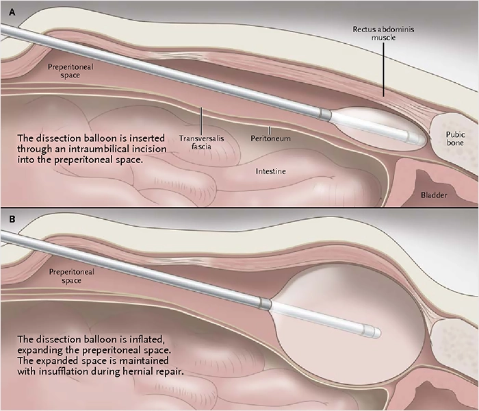 Totally Extraperioneal Repair TEP
