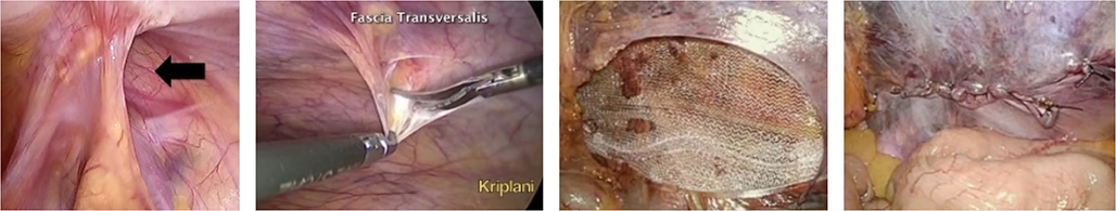 Trans-Abdominal Pre-Peritoneal Onarım TAPP