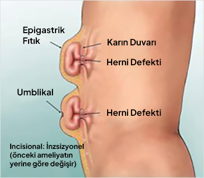 Ventral Herni